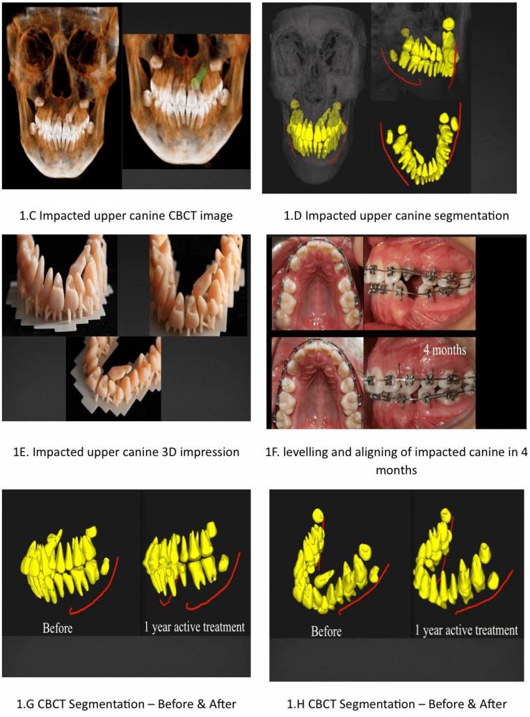 Diagnosis and Treatment plan of Maxillary Impacted canines using CBCT